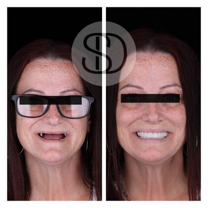 All-on-X BA2 All-on-X BA2